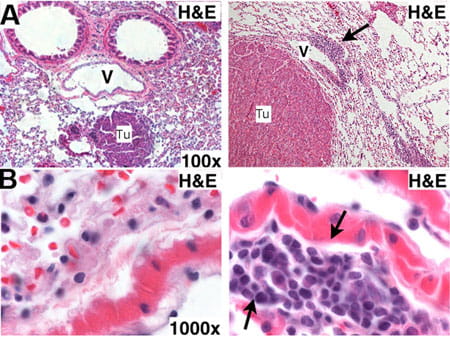 Increased perivascular leukocyte infiltration is associated with increased tumor sizes in enFoxm1−/− mice. 
